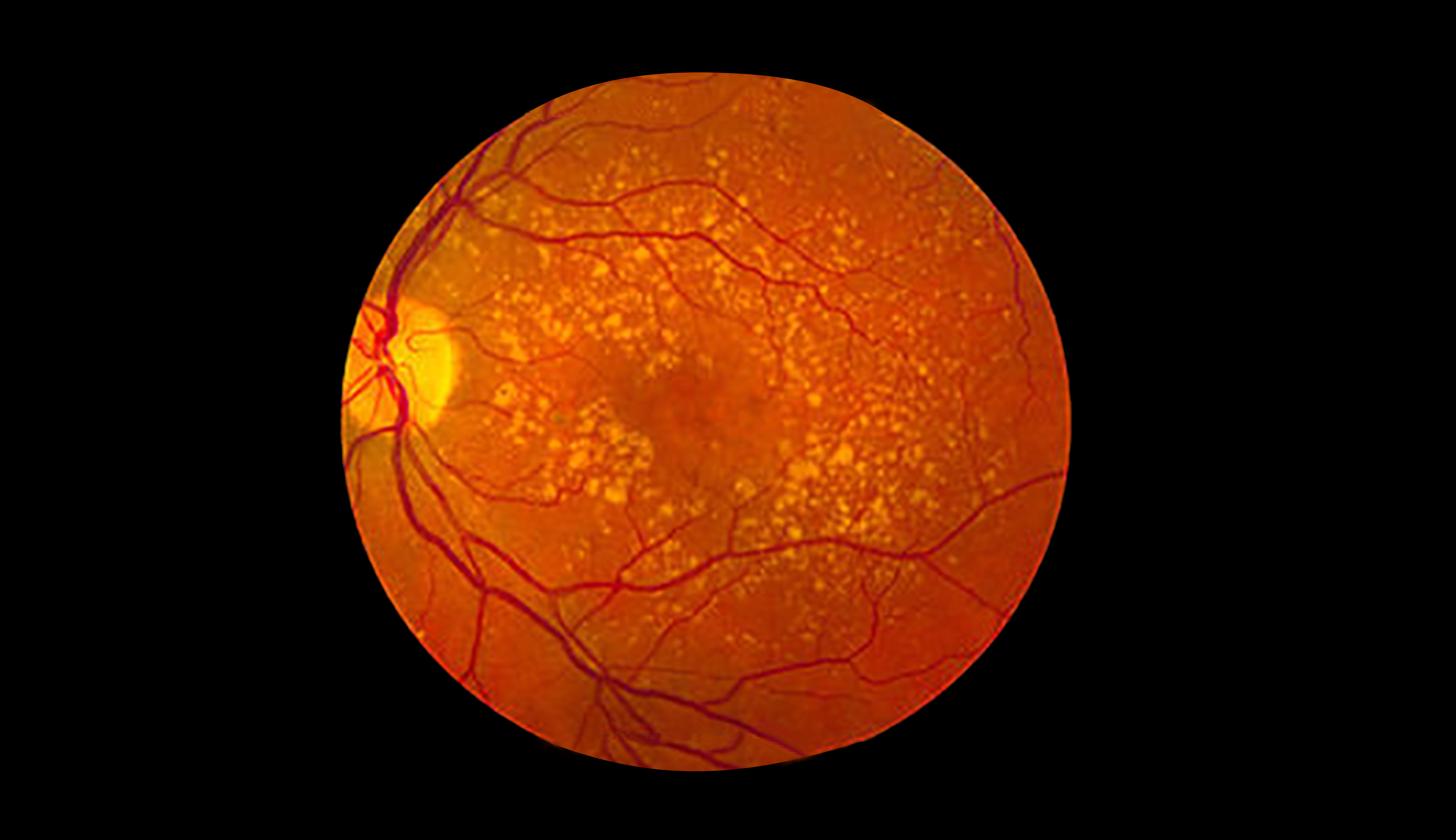 Foto da retina de uma pessoa mostrando o avanço da degeneração macular em estado médio