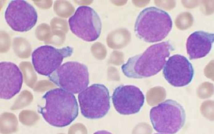 Esfregaço de aspiração da medula óssea de um paciente mostrando linfoblastos no sangue periférico de um paciente com leucemia linfoide aguda